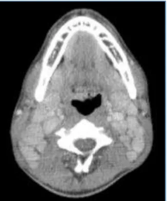 Fig. 2: Post Contrast Coronal CT Scan of Neck Showing  Homogeneous Brilliantly Enhancing Discrete Bilateral 