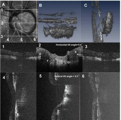 Fig. 2. Three-dimensional spectral domain (SD) optical coherence tomography (OCT) images of the lamina cribrosa (LC) and schematic explanation of the method for measuring LC tilt angle against Bruch’s membrane opening (BMO)