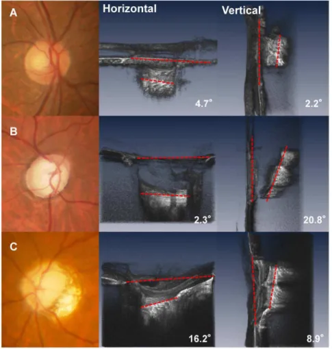 Fig. 4. Fundus image and horizontal and vertical optical coherence tomography (OCT) images of the lamina cribrosa (LC)