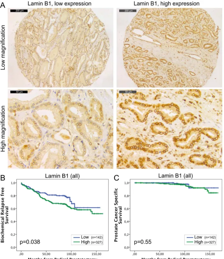 Fig 2. High lamin B1 expression in PCa predicts increased risk for BCR. (A) Representative examples of TMA slides stained for lamin B1 with immunohistochemistry