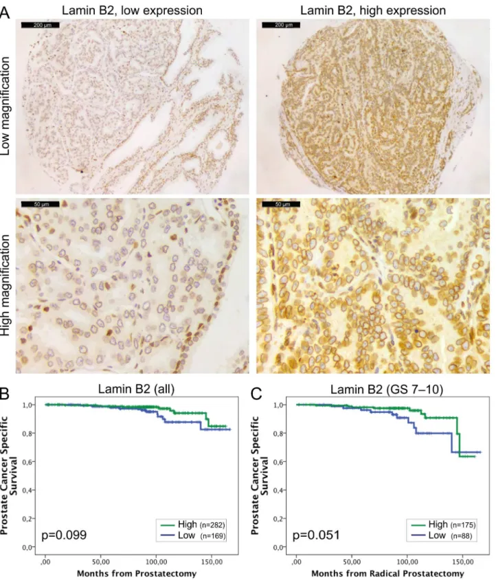 Fig 3. Low lamin B2 expression in PCa predicts shortened DSS. (A) Representative examples of TMA slides stained for lamin B2 with