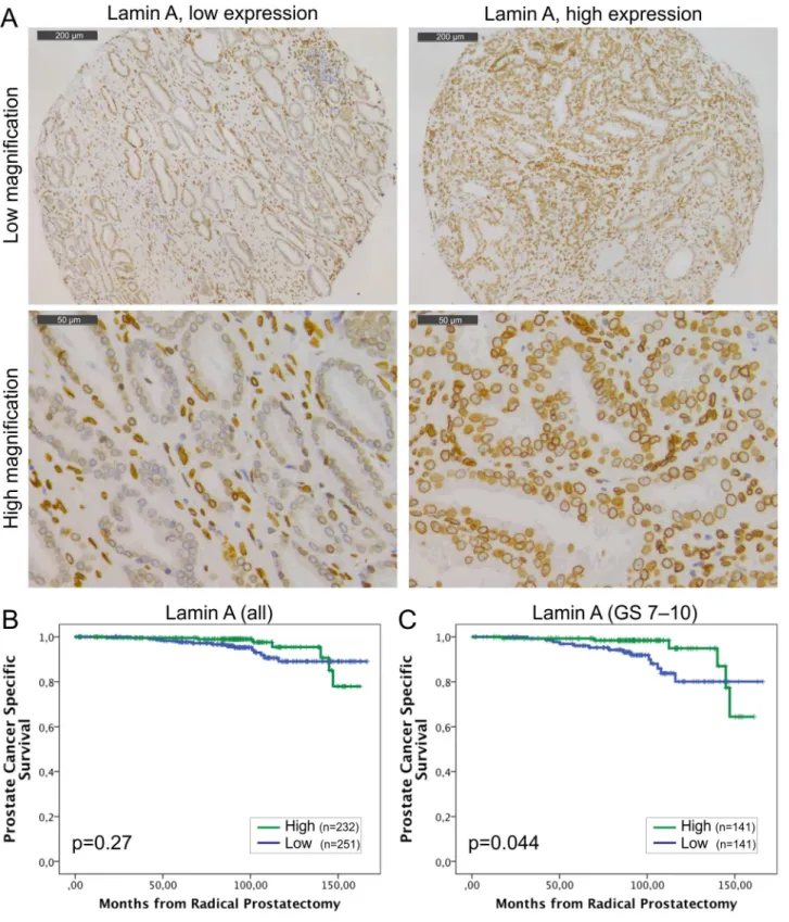 Fig 1. Low lamin A expression in PCa predicts unfavorable DSS. (A) Representative examples of TMA slides stained for lamin A with