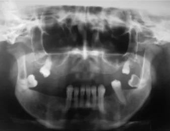 Figure 2 - Measurement of  maximum mouth opening between  teeth 11 and 41.