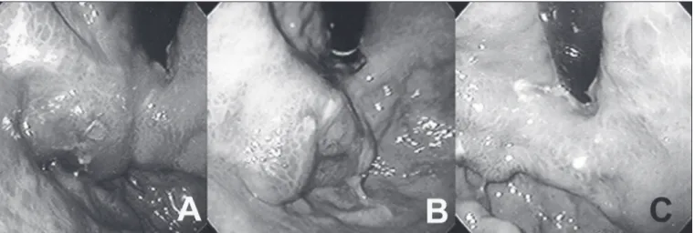 TABLE  1.  Results  of  elective  endoscopic  treatment  for  gastric  varices  with cyanoacrylate injection