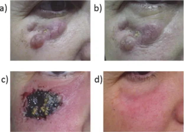 Figura 10 - Foto de um paciente com carcinoma basocelular na regi˜ ao do rosto (a). Nesta regi˜ ao procedimentos cir´ urgicos s˜ ao dif´ıceis de serem realizados