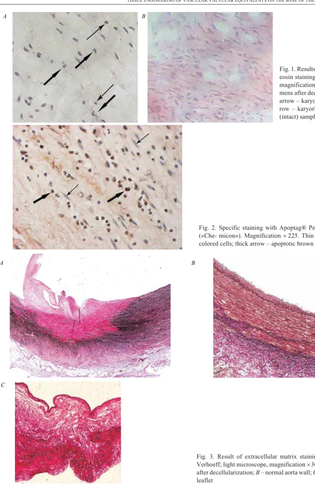 Fig. 1. Results of hematoxylin and eosin staining (light microscope, magnification ´ 400): A –  speci-mens after decellularization (thin arrow – karyopyknosis; thick  ar-row – karyorhexis); B – control (intact) samples