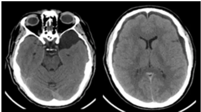 Figure  1  -  Initial  brain  CT  revealing  left  middle  cranial  fossa 