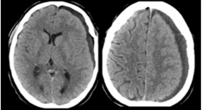Figure  5  -  Post-operative  brain  CT  scan  with  subdural  hygroma  resolution and reduction of arachnoid cyst volume