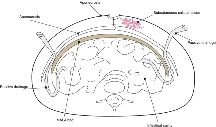 Figure 1 - Schematic representation of the MALA bag insertion.