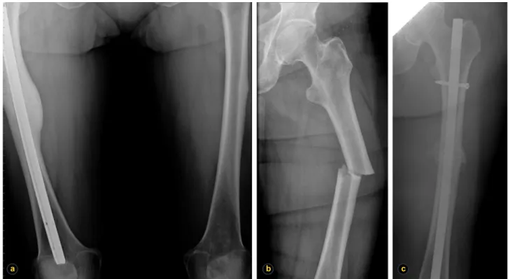 Figura 3 – Radiografias relativas à segunda fratura da doente do caso 2: a) diáfises dos fémures revelando pós-operatório de osteossínte- osteossínte-se endomedular anterógrada à direita e imagem de espessamento da cortical externa esquerda; b) fratura de 