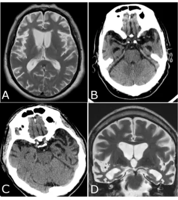 Figure 1 – Neuroimaging findings in FTLD.