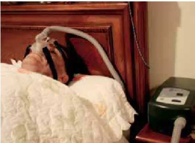 FIGURE 1 - CPAP (“continuous positive airway pressure”).