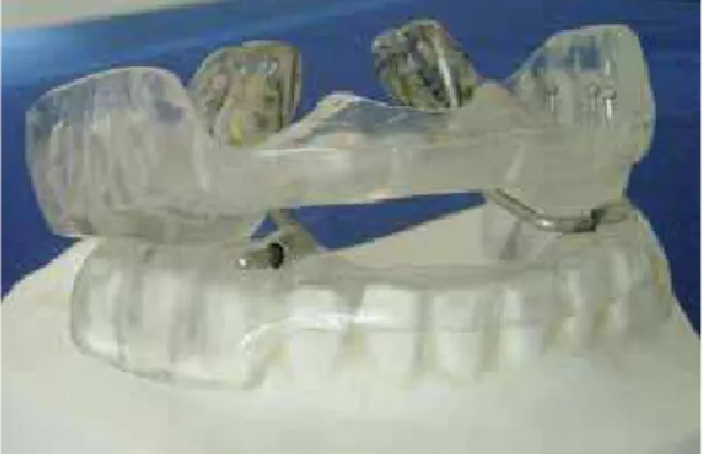 FIGURE 5 - BRD device used in the study.