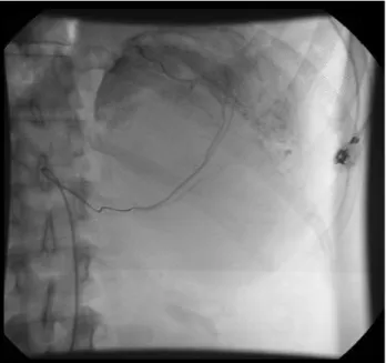 Figura 2: Angiografia abdominal: embolização das artérias nutriti- nutriti-vas da lesão com partículas de PVA.