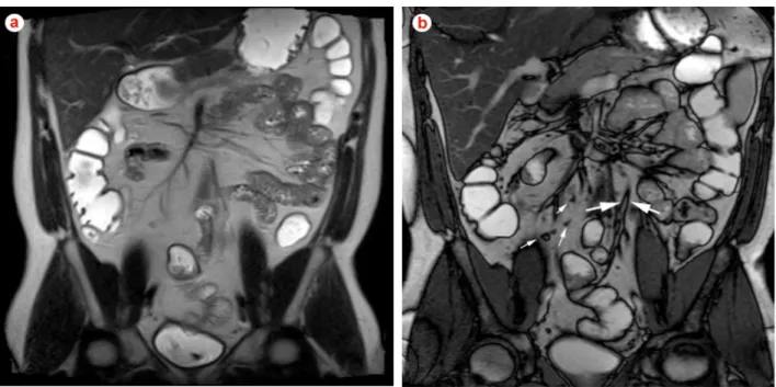 Fig. 2 –  Coronal T2-weighted SSETSE (a) and steady state free precession (b) images in a 32-year old woman with inactive Crohn’s  disease