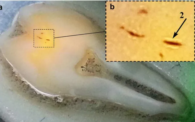 Fig 2. Appearance of the human tooth sample: representation of the human tooth sample irradiated by green laser with a wavelength of 514.5 nm (A); well visualized lighter areas of dental hard tissues (B).