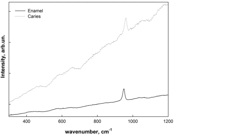 Fig 3 shows Raman scattering spectra obtained from the intact enamel as well as a typical spectrum of a microarea of carious fissure with deciduous demineralization (i.e