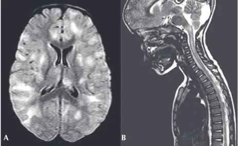 Fig. 2. (A) An axial fluid-attenuated inversion recovery magnetic resonance imaging (MRI)  of the brain in a child with acute disseminated encephalo pmyelitis demonstrates multifocal  areas of hyperintensity in both cerebral hemispheres involving cortical 