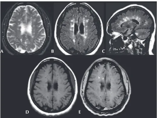 Fig. 3. Axial T2-weighted (A) and axial fluid-attenuated inversion recovery (FLAIR) (B) images show  multiple, ovoid shaped, hyperintense foci in the periventricular area, consistent with multiple sclerosis  plaques