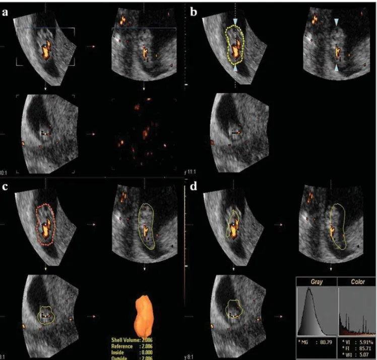 Figure 1. Measurement of 3D power Doppler vascularization indices (VI, FI and VFI) after 3D reconstruction of embryonic volume utilizing the VOCAL method with a 12° rotation angle