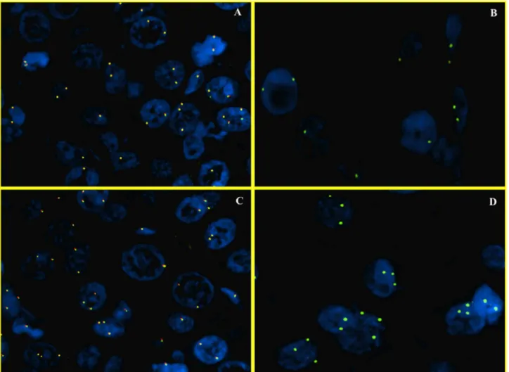 Figure 2.  FISH analysis of c-myc (wild status and gains of 8q).  Dual color fluorescence in situ hybridization with a centromere probe for chromosome 8 (CEP8, Spectrum Green), and region-specific probe for c-myc (Spectrum Orange), in representative foci o