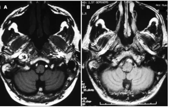 Fig 1. T1-weighted brain MRI axial sec- sec-tion, with fat suppression technique. 