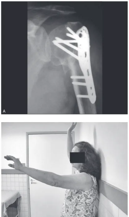 Figura 4 – A) Radiografia do ombro demonstrando fratura conso- conso-lidada com desvio em varo