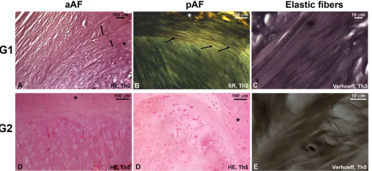 Fig 3. Light microscopy slides. A well-delimited structure of fibrous lamellae in both anterior and posterior AF of G1 discs is substituted for a degenerated phenotype in G2 with compact, fibrocartilaginous matrix populated with numerous chondrocyte cluste
