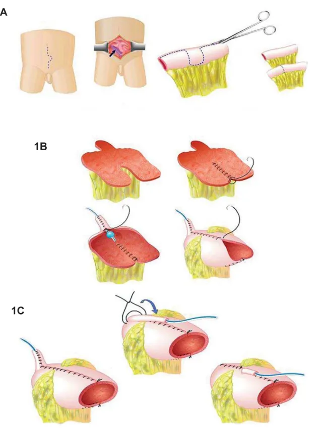 Figure 1 – Macedo’s continent catheterizable reservoir - surgical technique. Reproduced from Macedo A