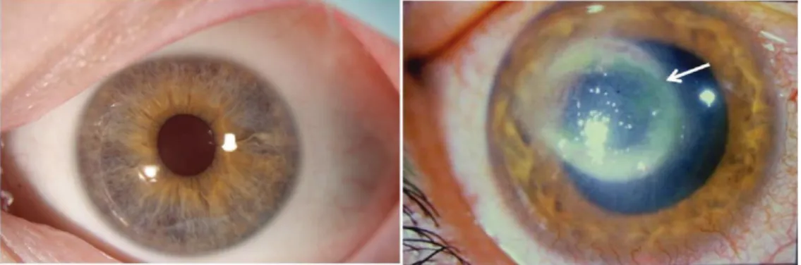 Figure  4.1  -  A)  Normal  human  eye;  B)  Eye with  AK.  The  ring-like  stromal  infiltrate  (pointed with the arrow) is a characteristic feature of AK