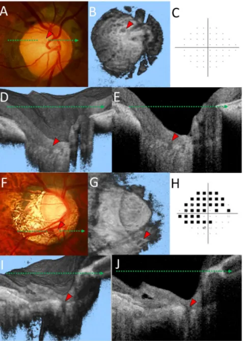 Fig. 3. Representative cases of a healthy highly myopic eye with enlarged lamina pores (A–E) and an eye with primary open angle glaucoma and lamina cribrosa (LC) defects (F–J)