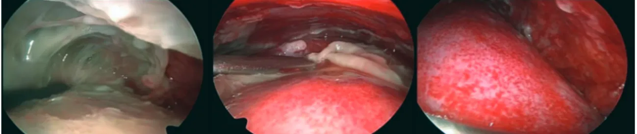 Figure 1 - Thoracoscopic view in pediatric patients with pleural empyema. In this example, a large quantity of fibrins  impedes lung expansion