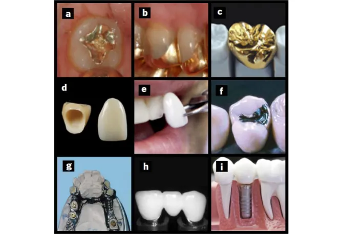 Figure 3 Dental restorations types: a) inlay b) onlay c) golden crown d) ceramic crowns e) venner f) dental amalgam g)  removable prosthesis h) Bridge i) Dental implant [11,23,29–34].