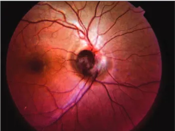 Figura 1:  Retinografia - Observou-se lesão pigmentada, sobrelevada e arredondada, no quadrante temporal inferior do disco óptico do olho direito