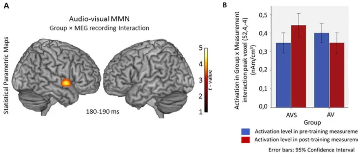 Figure 4. Rendering of the Statistical Parametric Maps of the generators of audio-visual, auditory and visual MMN as revealed by the one sample t-test analysis
