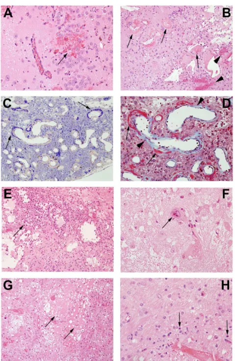 Fig 5. Pathological features in post-irradiation mouse brain. A. Micro-hemorrhage and dilated vessels (arrow, 20X); B