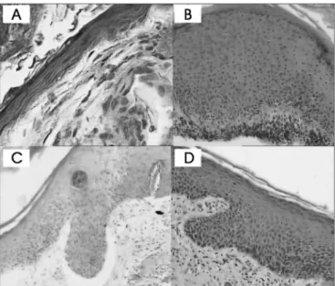 Figure 1. Cholesteatoma fragments: A- Atrophy (HE - 400x) B- Acantho- Acantho-sis (HE - 100x) C and D- Formation of epithelial cones (HE - 100x)