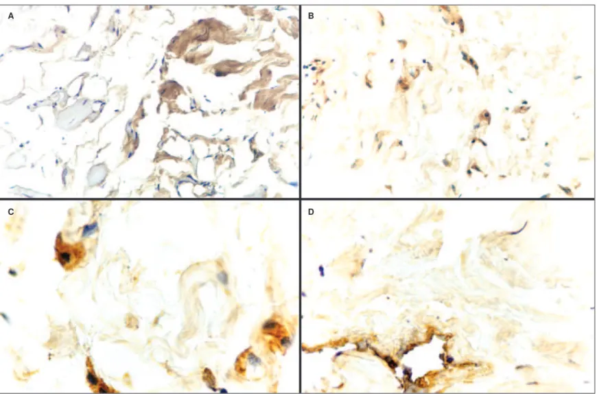 Figure 1 - (A) IGF-1 positive immunoexpression in connective tissue. Muscle fibers IGF-1 immunoexpression negative