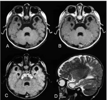 Fig 2. MRI, serial T1-weighted (A), T1-weighted after gadolinium injec- injec-tion (B), luid-attenuated inversion recovery (FLAIR) sequence (C)  ax-ial images and T2-weighted sagital image (D) show bilateral lesions  with signal intensity that is isointens