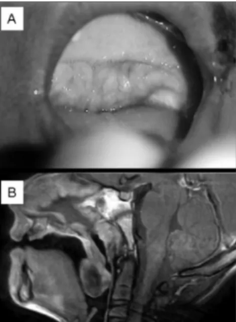 Figure  1.  Tumor  invading  the  soft  palate  and  tonsillar  pillars.