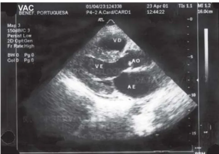 Fig. 1 – Echocardiogram evidenced deposit disease (observe the ventricular septum)