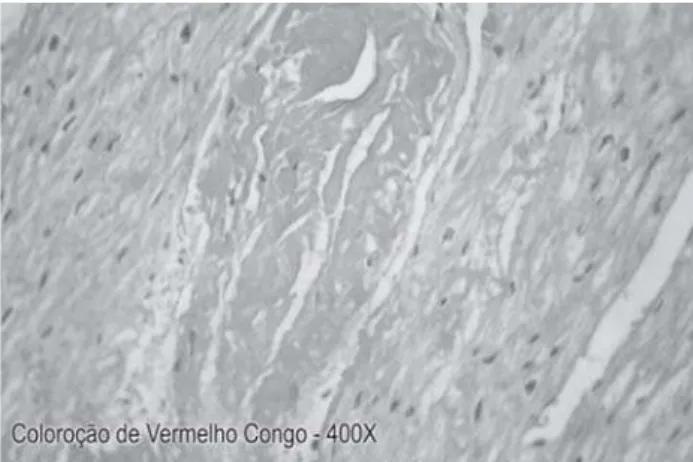 Fig. 4 – Endomyocardic Biopsy with 5 year - evolution, displaying absence of infiltrated  amyloid