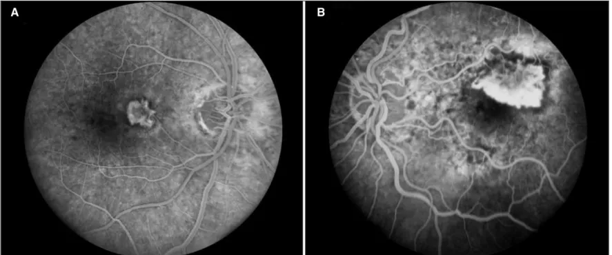 Figure 2 - (A) Fluorescein angiogram of study patient number 1 with classic extrafoveal CNV nasal to fovea (large arrow) in eye with atrophy temporally (small arrow);  (B) Intraretinal fluid demonstrated by OCT prior to treatment; (C) OCT of same macular c