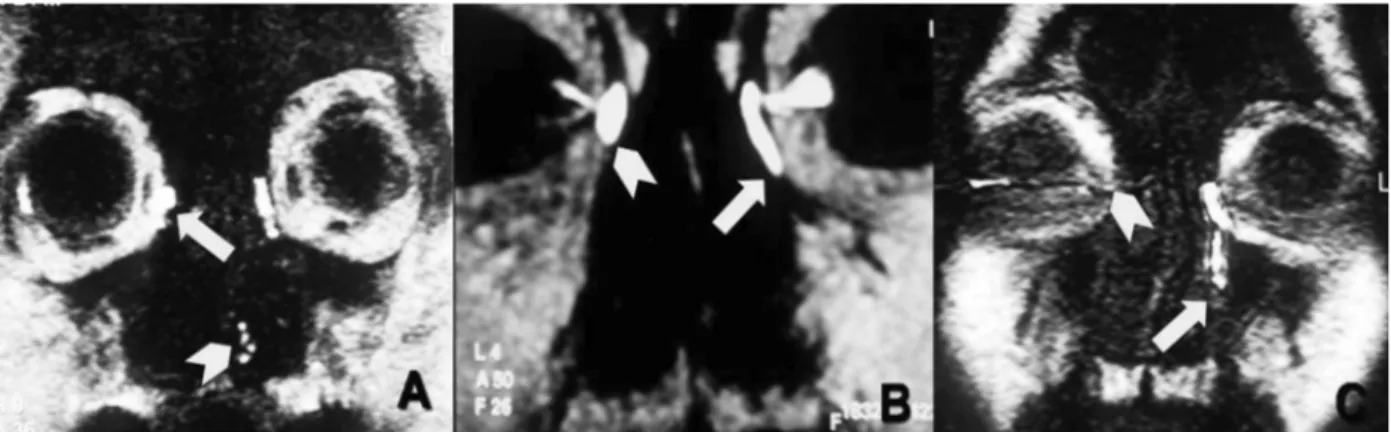 Figure 2. Obstruction levels on the coronal plain on MR-DCG imagings. (A) Obstruction is observed at the common  canaliculus-lacrimal sac union on the right (at the level of the Rosenmuller valve, level 1) (arrow), contrast medium  passage is present and t