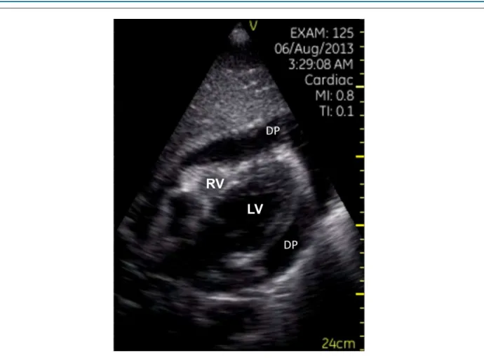 Figure 3 – Signiicant pericardial effusion (DP) in the subcostal plane showing signs of restricted ventricular illing in a patient with cardiac tamponade