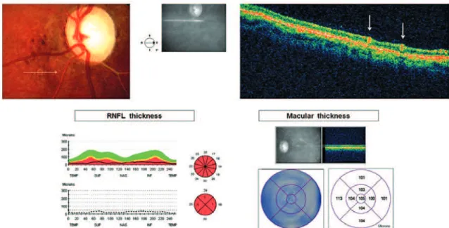 Figure 2. Above: The line scan protocol of Stratus-OCT passing through the worm location (horizontal white arrow), documenting two hyper reflective points in intraretinal space above the pigment ephithelium-choriocapillary complex (vertical white arrows)