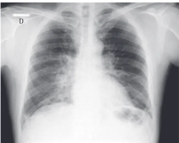 Figure 1 - Chest X-ray at admission.