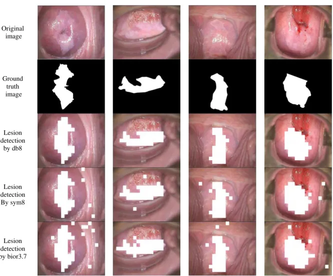 Fig. 3.  The detected lesion based on the proposed system for three wavelets 