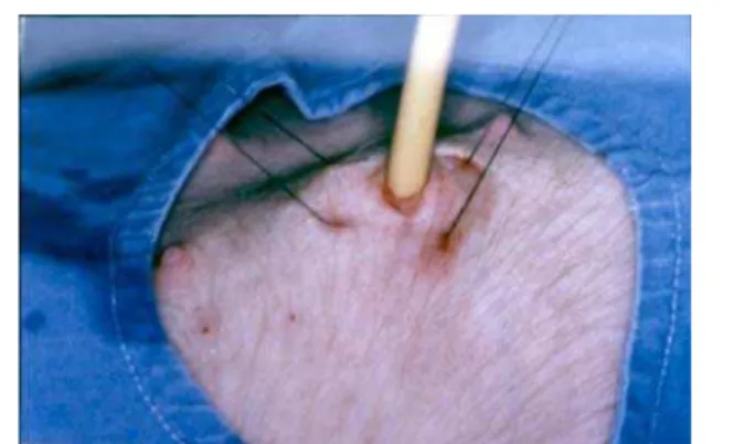 FIGURE 7 - Surgery view of urological trocar been introduced on the skin until the gastric lumem.