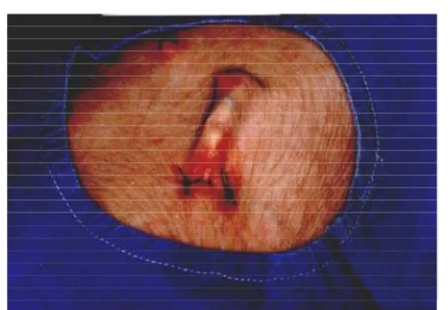 FIGURE 13 - Foley catheter is occluded four cm above the skin.